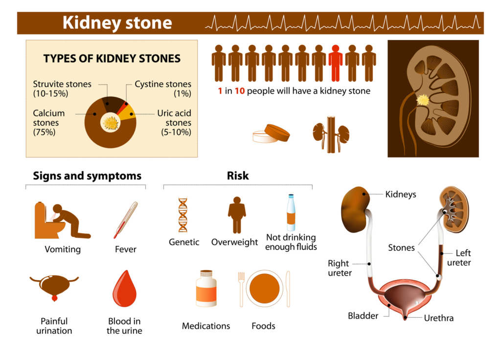 actual kidney stone size chart in mm