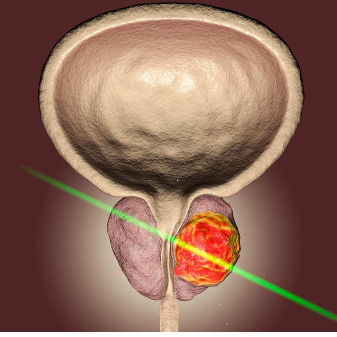 Green Light Laser para tratamento de hiperplasia benigna da próstata