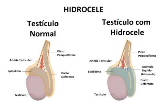 Hidrocele e o tratamento cirurgico para hidrocele