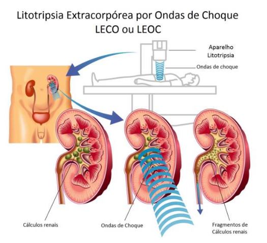 litotripsia extracorporea