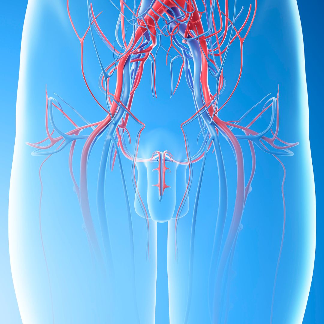 tratamento microcirurgico de varicocele