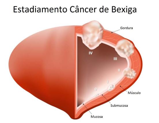 desenho dos estágios do câncer de bexiga