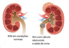 Ureterrenolitotripsia Rigida