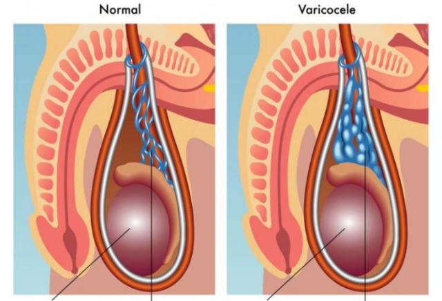 Desenho da varicocele para explicar o tratamento microcirurgico para varicocele